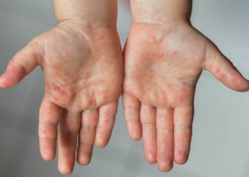 Measles Outbreak Strikes Punjab: Over 2,000 Cases Reported in Two Months